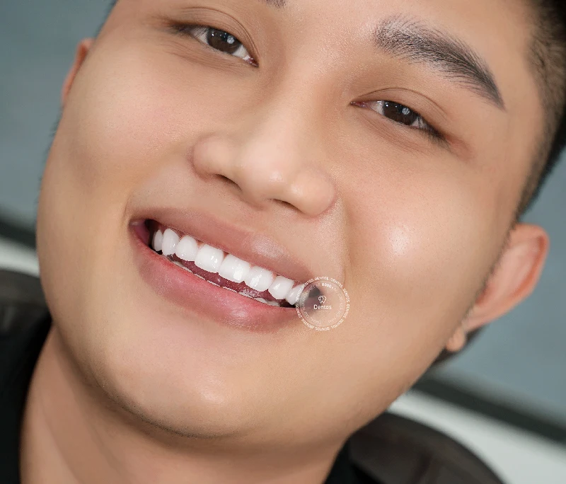 Răng bọc sứ chuẩn y khoa có độ bền và thẩm mỹ cao hơn phủ sứ nano